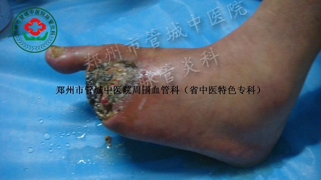 脉管炎的晚期症状