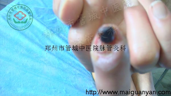 脉管炎的症状2-管城中医院脉管炎科