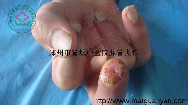 脉管炎的中医治疗1