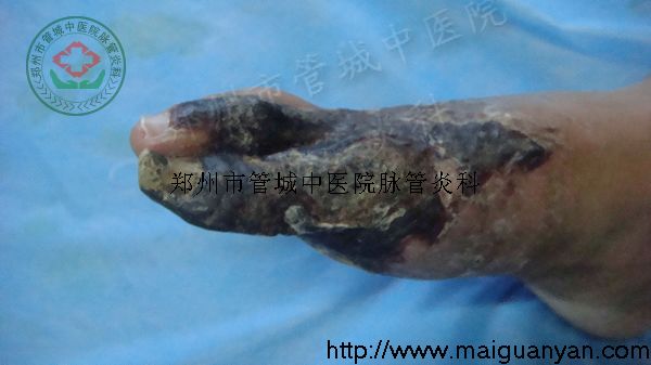 脉管炎症状初期