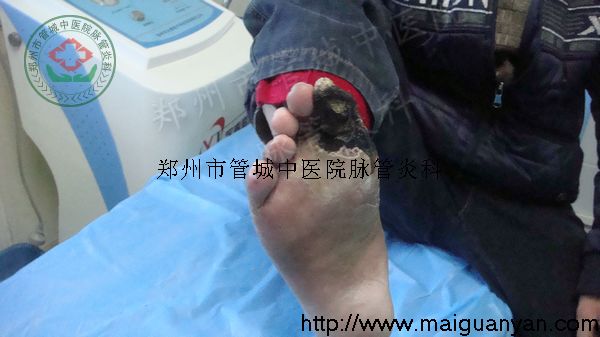 入院时脉管炎症状