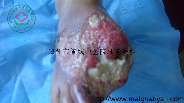 脉管炎治疗过程