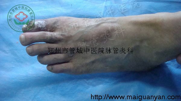 血栓闭塞性脉管炎