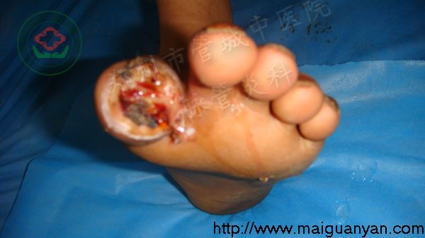 脉管炎症状图片