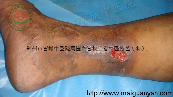 血栓性静脉炎的图片*