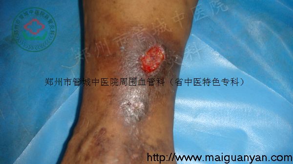 静脉炎症状图片