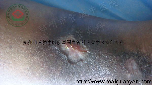 静脉炎治疗康复