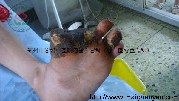 血栓闭塞性脉管炎的症状