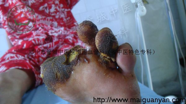 脉管炎晚期症状图片