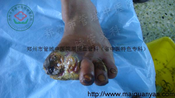 血栓闭塞性脉管炎(第三期Ⅱ级)