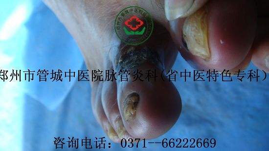 脉管炎早期症状