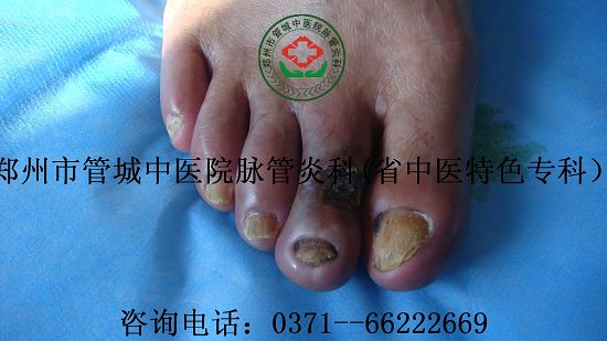 血栓闭塞性脉管炎症状