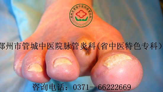 脉管炎中医治疗