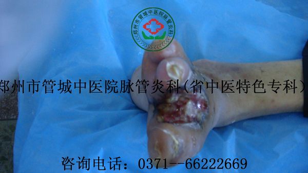 脉管炎患者入院