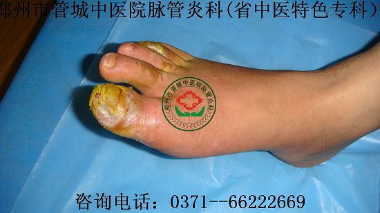 脉管炎的症状图片2