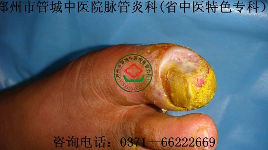 脉管炎入院图片