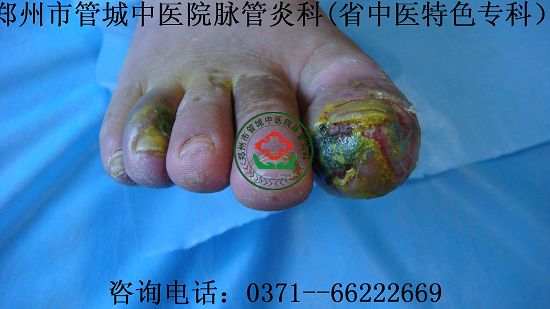 脉管炎中医治疗