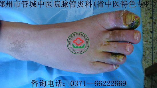 治疗脉管炎的方法