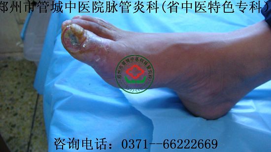 治疗脉管炎的医院