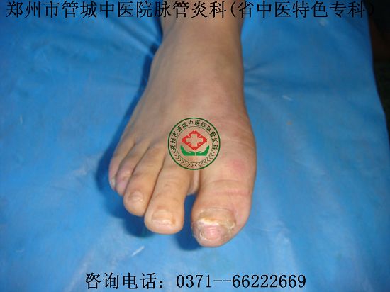 脉管炎医院治愈脉管炎