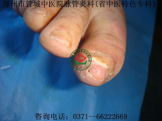 脉管炎医院治愈脉管炎