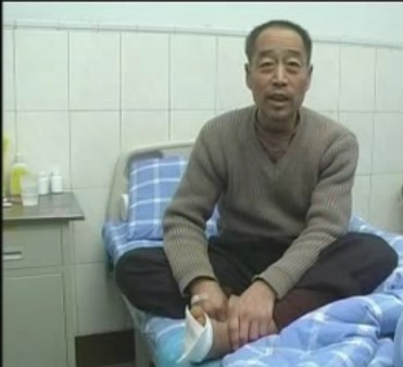 血栓闭塞性脉管炎