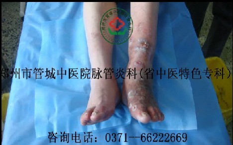 脉管炎症状图片