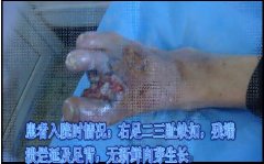 血栓闭塞性脉管炎患者康复出院，视频介绍