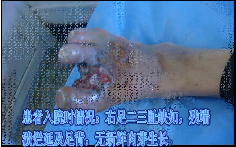 血栓闭塞性脉管炎患者