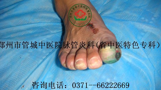 脉管炎症状图片