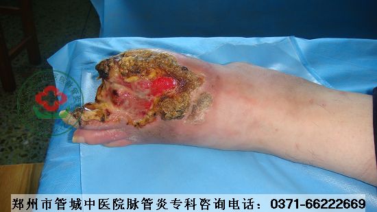 脉管炎症状严重图片