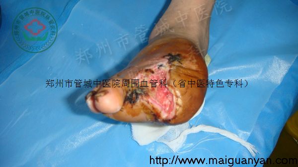 脉管炎的症状图片
