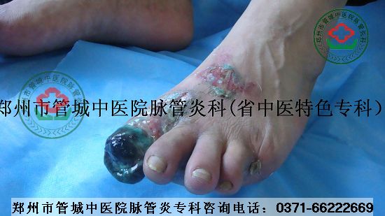 急性脉管炎症状图片