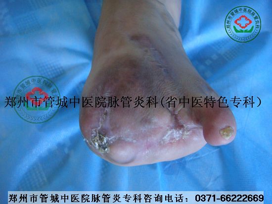 Âö¹ÜÑ×Ö¢×´