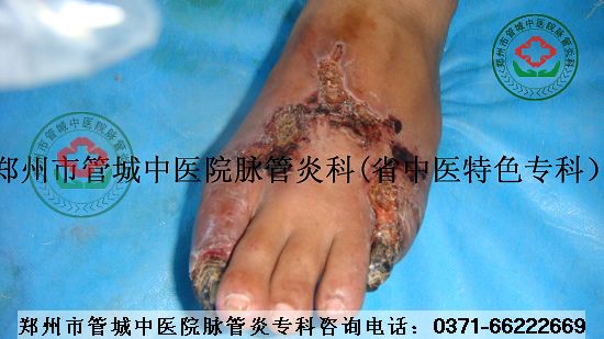 中医治疗动脉硬化