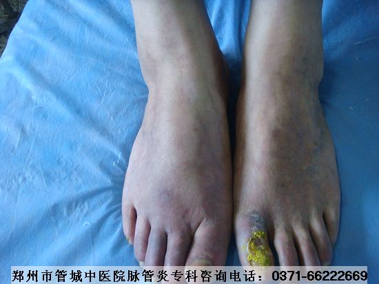 血栓闭塞性脉管炎