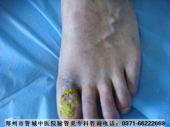 脉管炎症状治疗