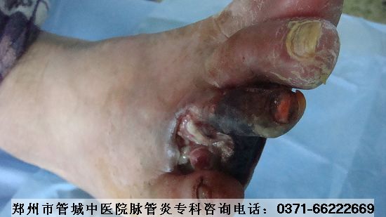 脉管炎症状图片一