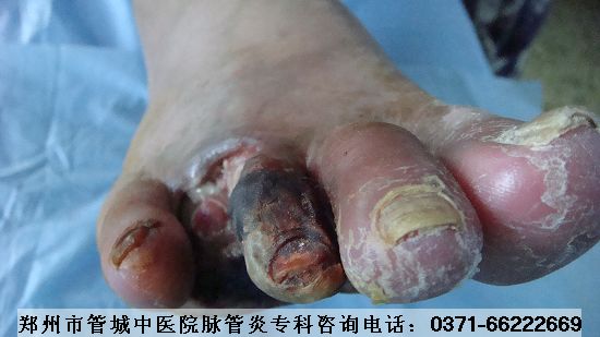 脉管炎入院图片