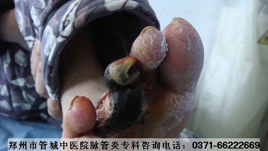 脉管炎的症状图片二