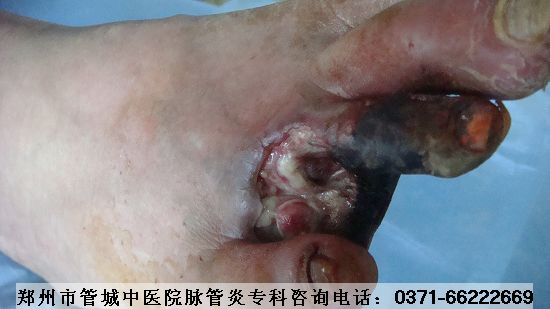 脉管炎如何治疗