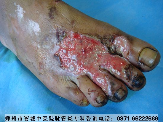 Âö¹ÜÑ×´¦ÀíÉË¿Ú