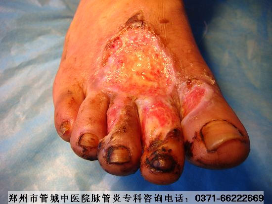 Âö¹ÜÑ×ÈçºÎÖÎÁÆ