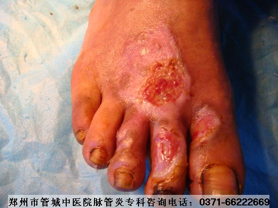 ÖÎÁÆÂö¹ÜÑ×µÄÒ½Ôº