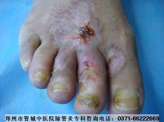 Âö¹ÜÑ×ÖÎÁÆ