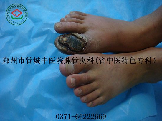 脉管炎中期症状