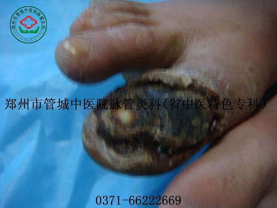 脉管炎症状介绍