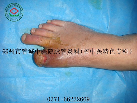 脉管炎中医治疗